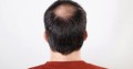 Alopecia Androgenetica: cause, sintomi e trattamenti